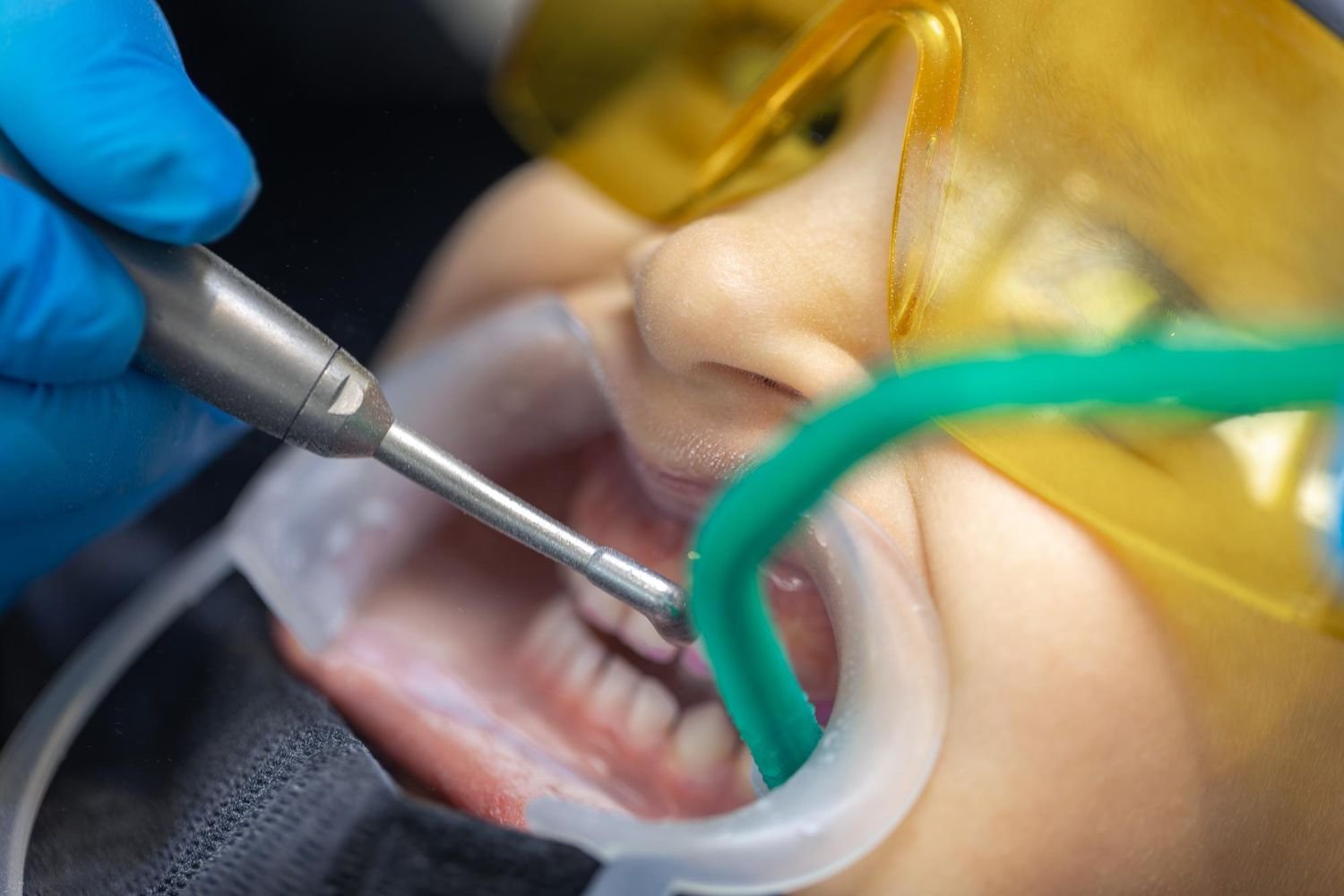 Scaling and Polishing – Dental Hygiene Maintenance